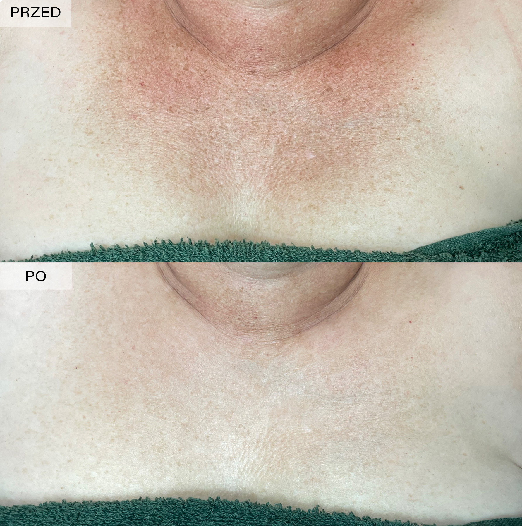 fototerapia ipl efekty